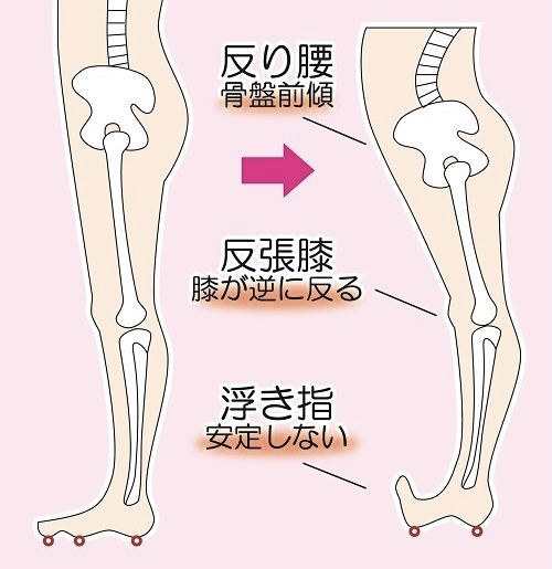 反張膝特徴